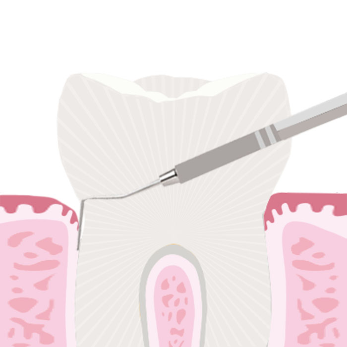 牙周治療 (再生手術)