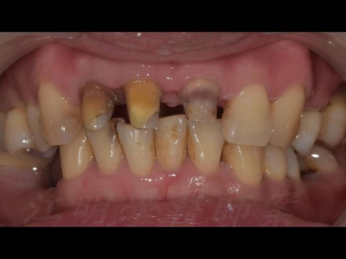 全口重建+門牙根管治療