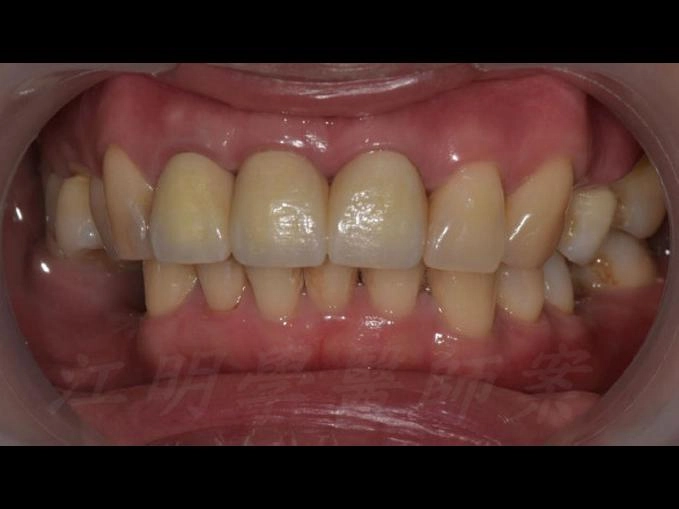 全口重建+門牙根管治療