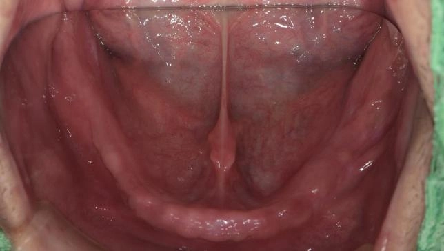 BPS全口假牙治療