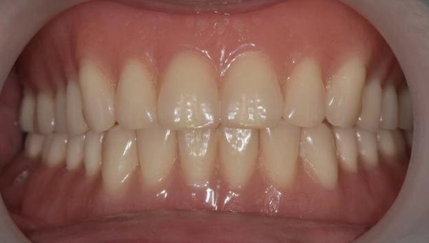 BPS全口假牙治療