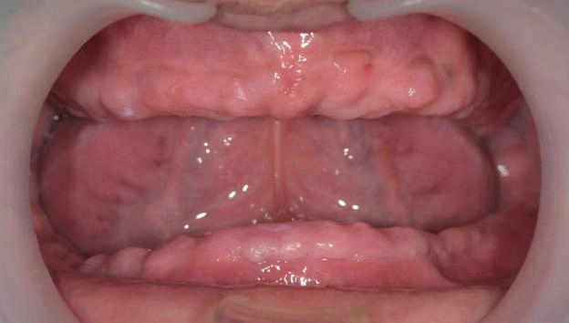 BPS全口假牙治療