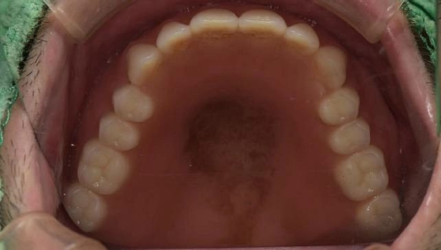 BPS全口假牙治療
