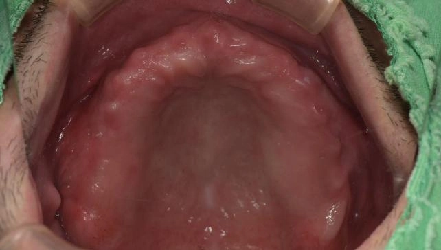 BPS全口假牙治療