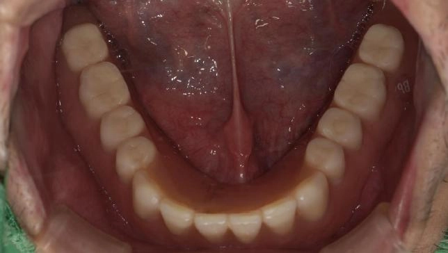 BPS全口假牙治療