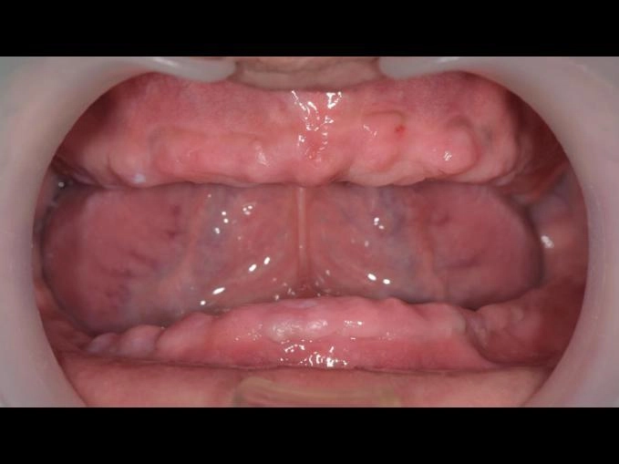 BPS全口假牙治療