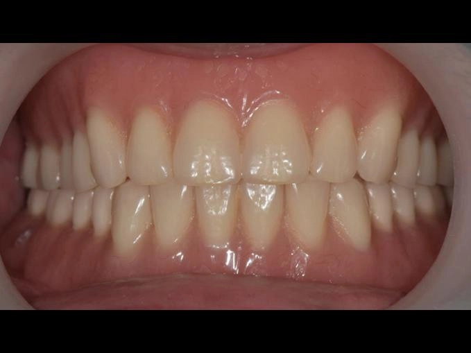 BPS全口假牙治療