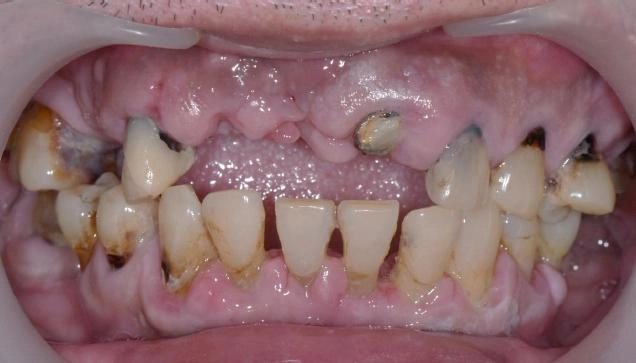 BPS全口假牙治療