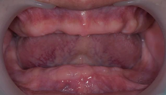 BPS全口假牙治療