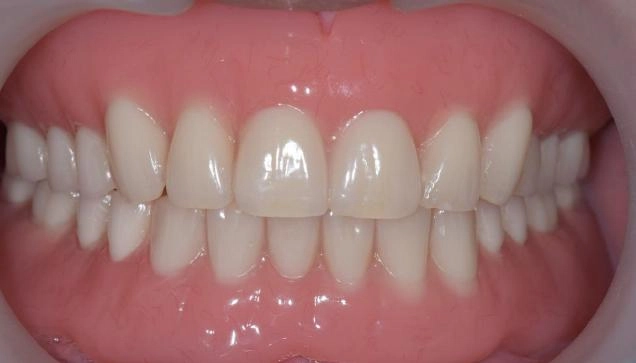 BPS全口假牙治療