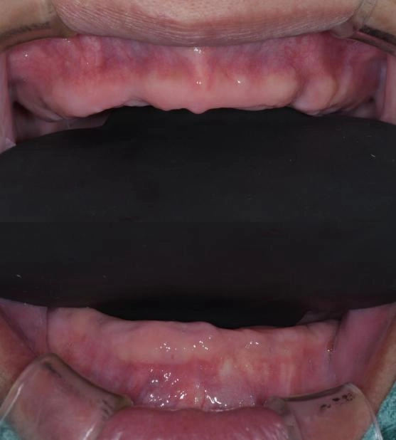 BPS全口假牙治療