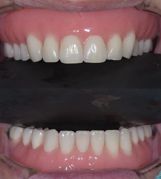 BPS全口假牙治療