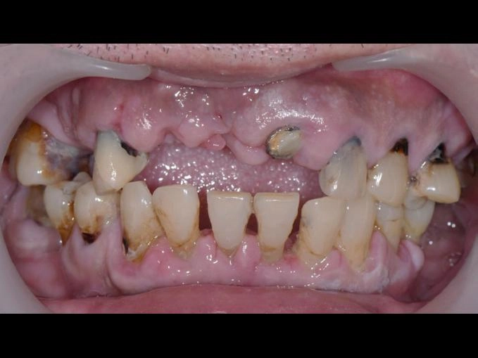 BPS全口假牙治療