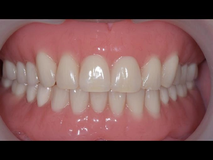 BPS全口假牙治療