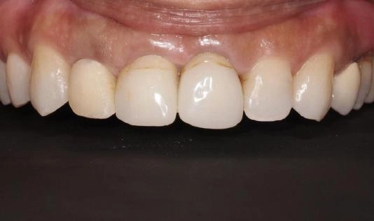 前牙假牙案例
