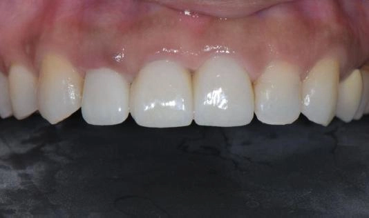 前牙假牙案例