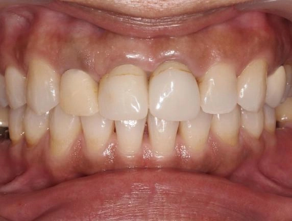 前牙假牙案例