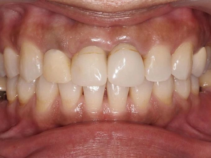 前牙假牙案例