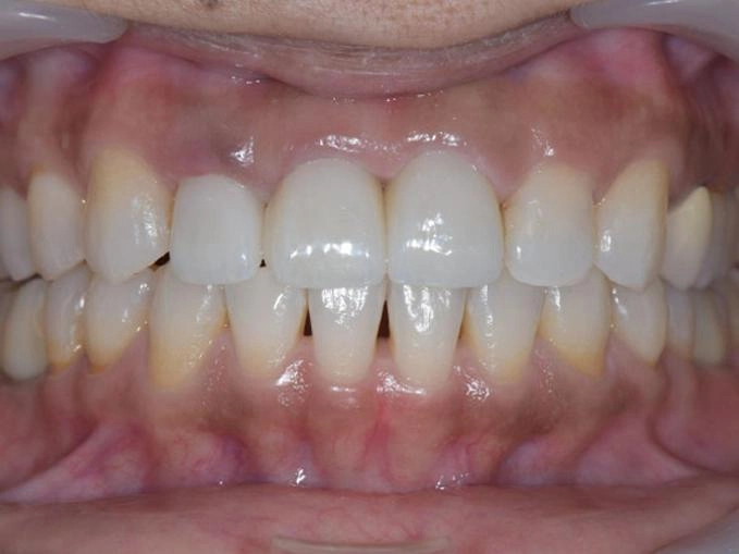 前牙假牙案例