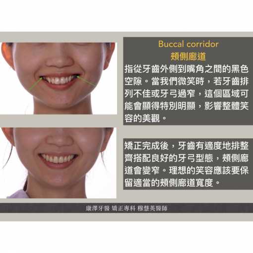 什麼是 Buccal Corridor（頰側廊道）
