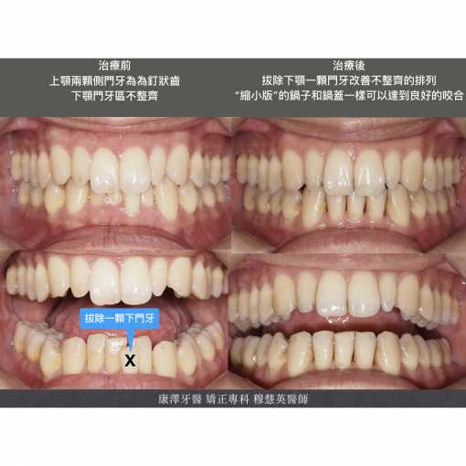 【矯正專欄】理想咬合的秘密：牙齒大小與數量的關鍵影響