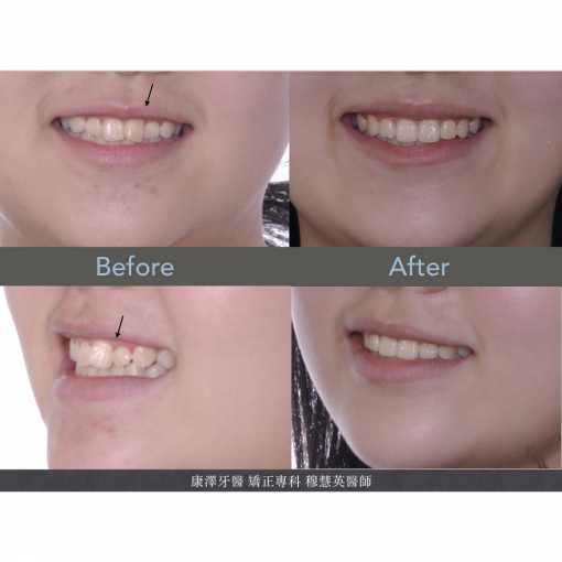 輕微牙齒不整齊？別小看矯正帶來的驚人改變！
