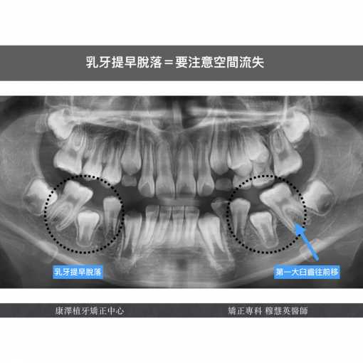 【矯正醫師提醒】乳牙早掉，不一定是好事！——如何預防恆牙萌發問題？