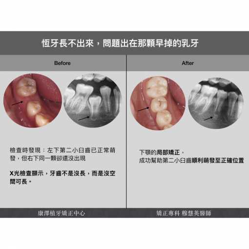 國小學生局部矯正案例｜恆牙長不出來？原來是乳牙太早掉了！