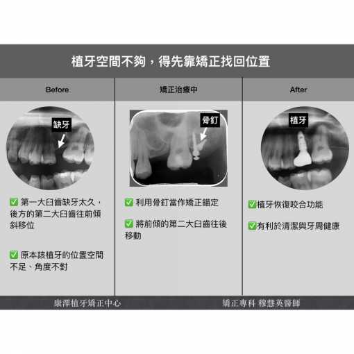 【植牙空間不夠，得先靠矯正找回位置】
