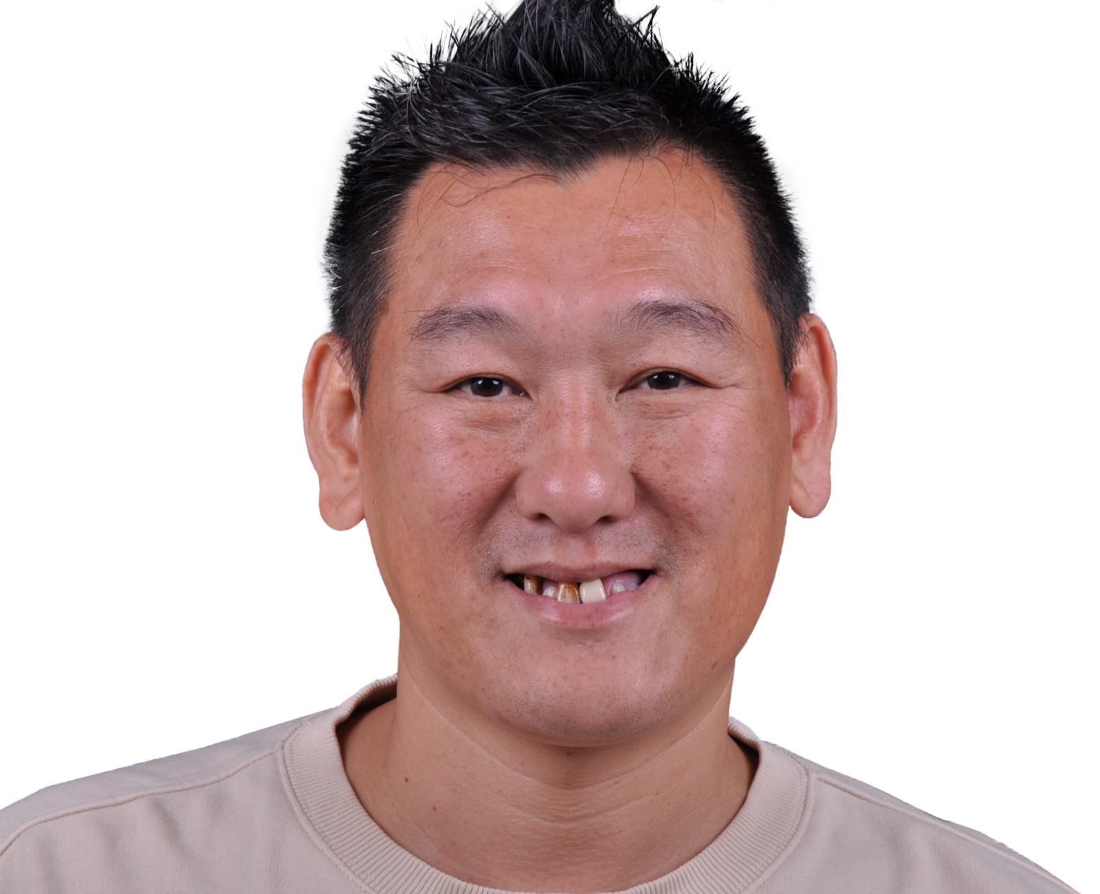 All-on-4 一日全口重建