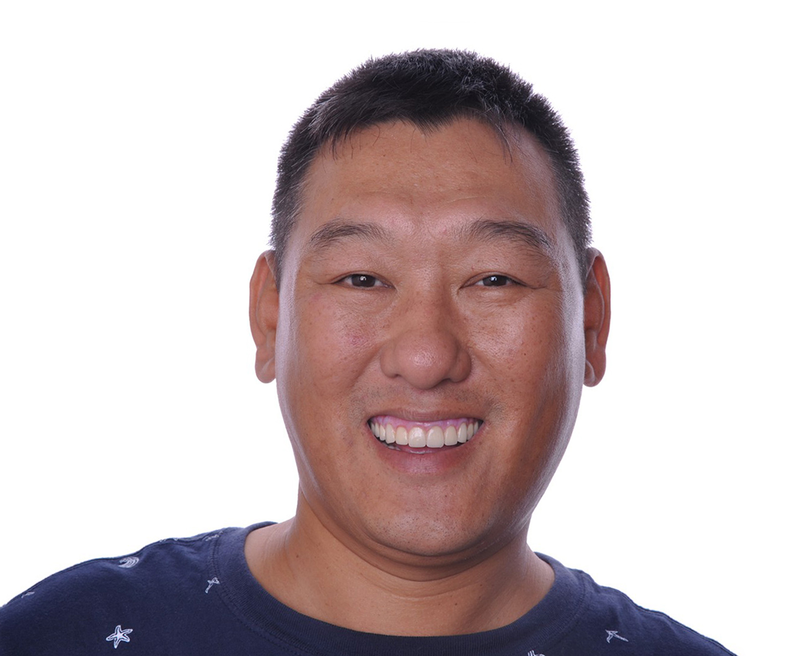 All-on-4 一日全口重建