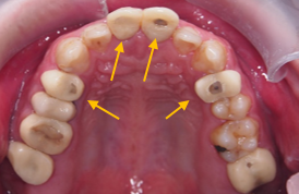 牙周治療->矯正->貼片
