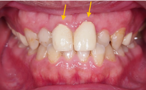 牙周治療->矯正->貼片