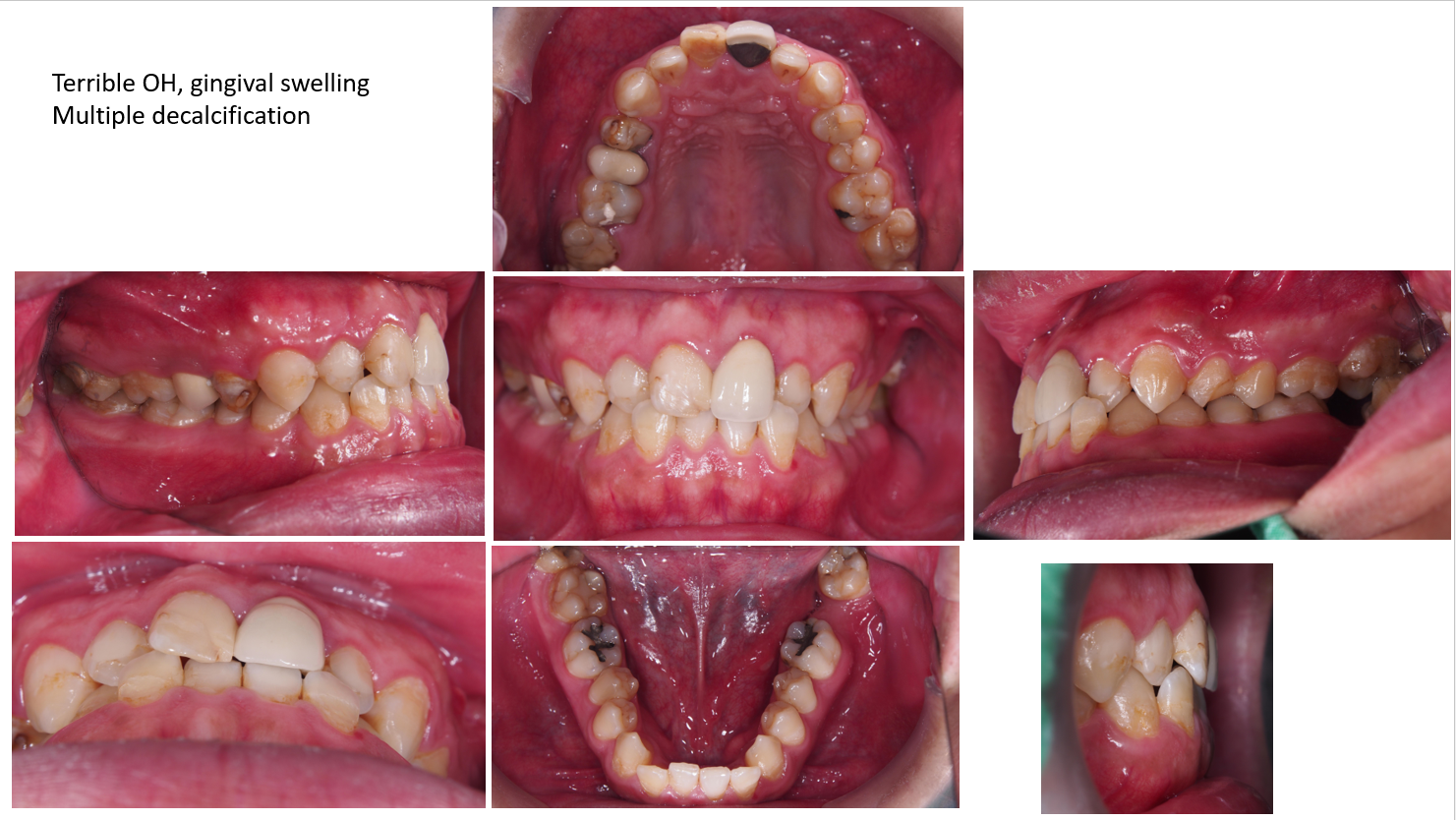 牙周治療->矯正->貼片