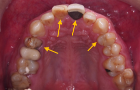 牙周治療->矯正->貼片
