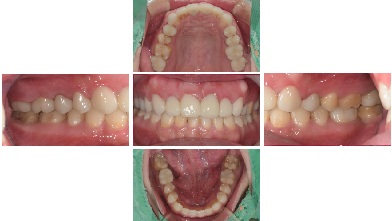 牙周治療->矯正->貼片