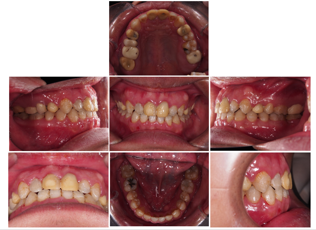 牙周治療->矯正->貼片