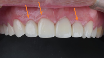 牙周治療->矯正->貼片