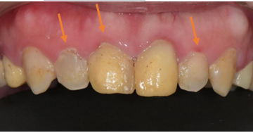 牙周治療->矯正->貼片