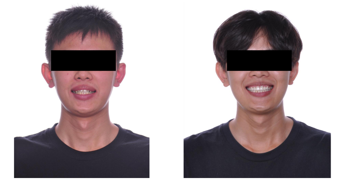 矯正+假牙+貼片+牙周合作全口重建 矯正+假牙+貼片+牙周合作全口重建