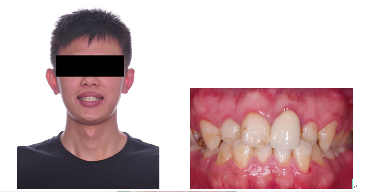 牙周治療->矯正->貼片