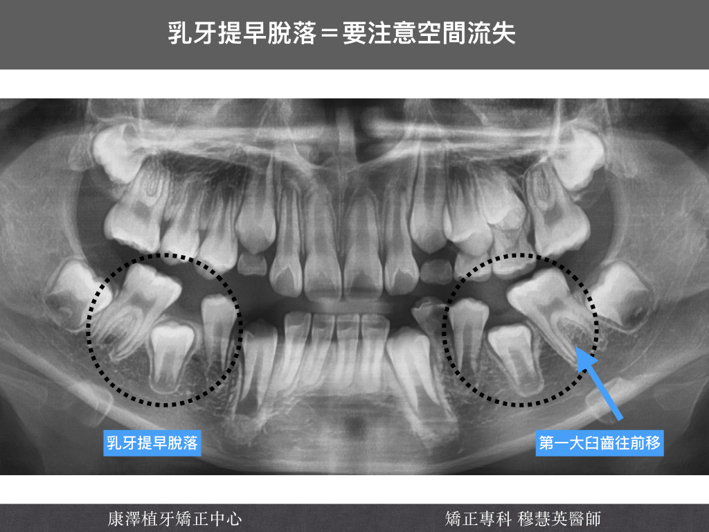 【矯正醫師提醒】乳牙早掉,不一定是好事!——如何預防恆牙萌發問題? 【矯正醫師提醒】乳牙早掉,不一定是好事!——如何預防恆牙萌發問題?