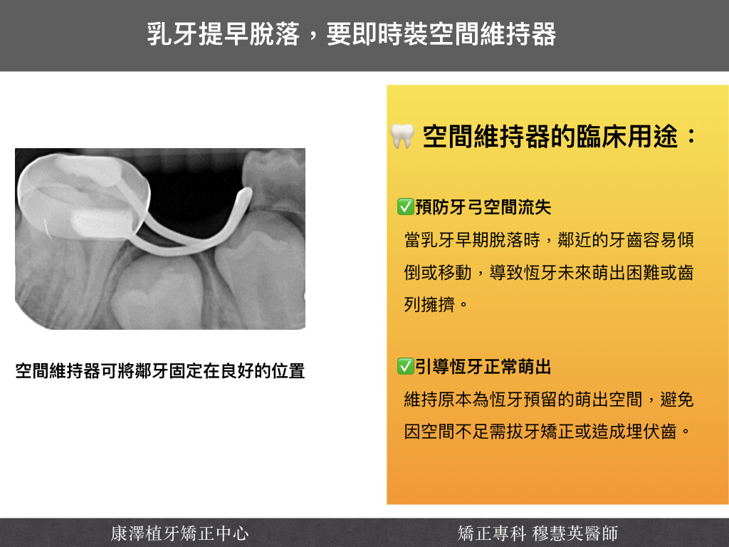【矯正醫師提醒】乳牙早掉,不一定是好事!——如何預防恆牙萌發問題? 【矯正醫師提醒】乳牙早掉,不一定是好事!——如何預防恆牙萌發問題?