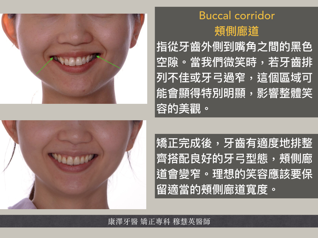 什麼是 Buccal Corridor(頰側廊道) 什麼是 Buccal Corridor(頰側廊道)