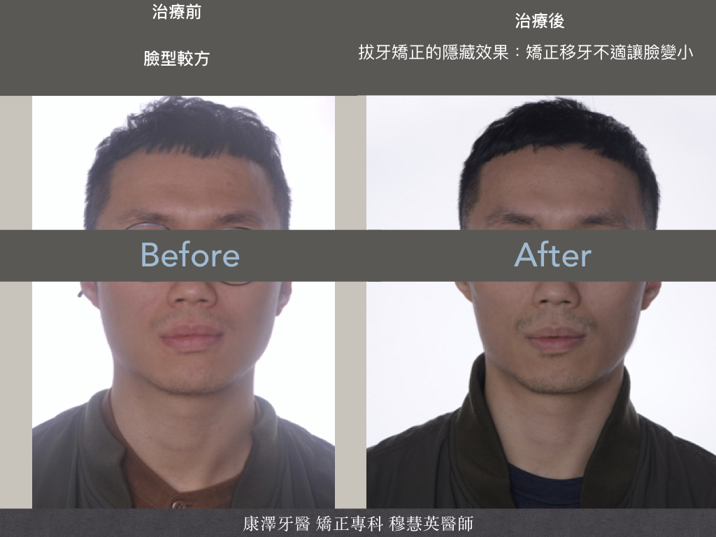 【矯正專欄】理想咬合的秘密:牙齒大小與數量的關鍵影響 【矯正專欄】理想咬合的秘密:牙齒大小與數量的關鍵影響