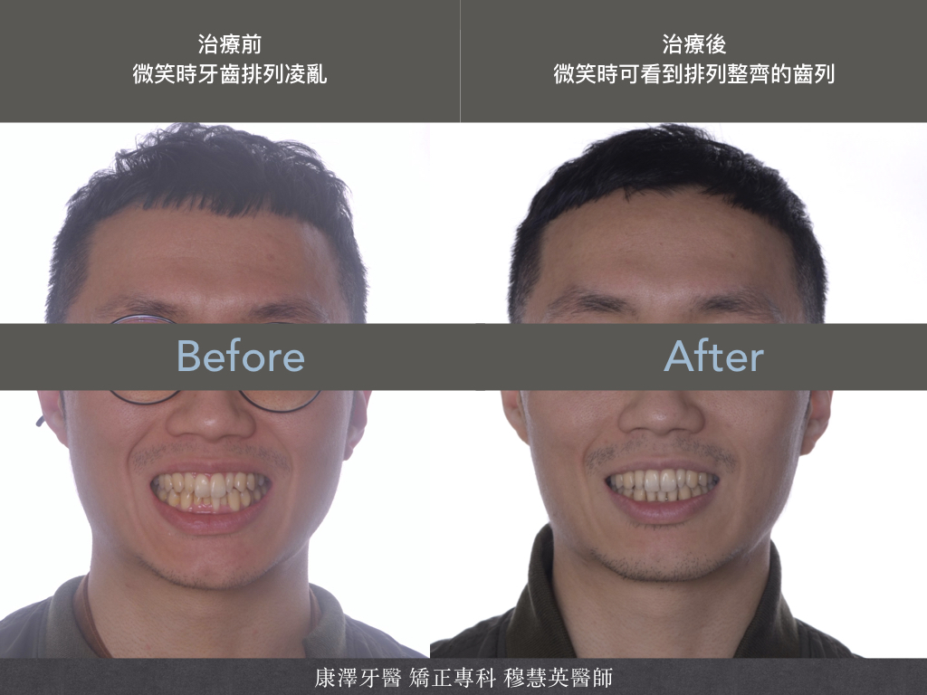 【矯正專欄】理想咬合的秘密:牙齒大小與數量的關鍵影響 【矯正專欄】理想咬合的秘密:牙齒大小與數量的關鍵影響