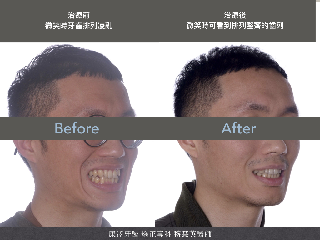 【矯正專欄】理想咬合的秘密:牙齒大小與數量的關鍵影響 【矯正專欄】理想咬合的秘密:牙齒大小與數量的關鍵影響