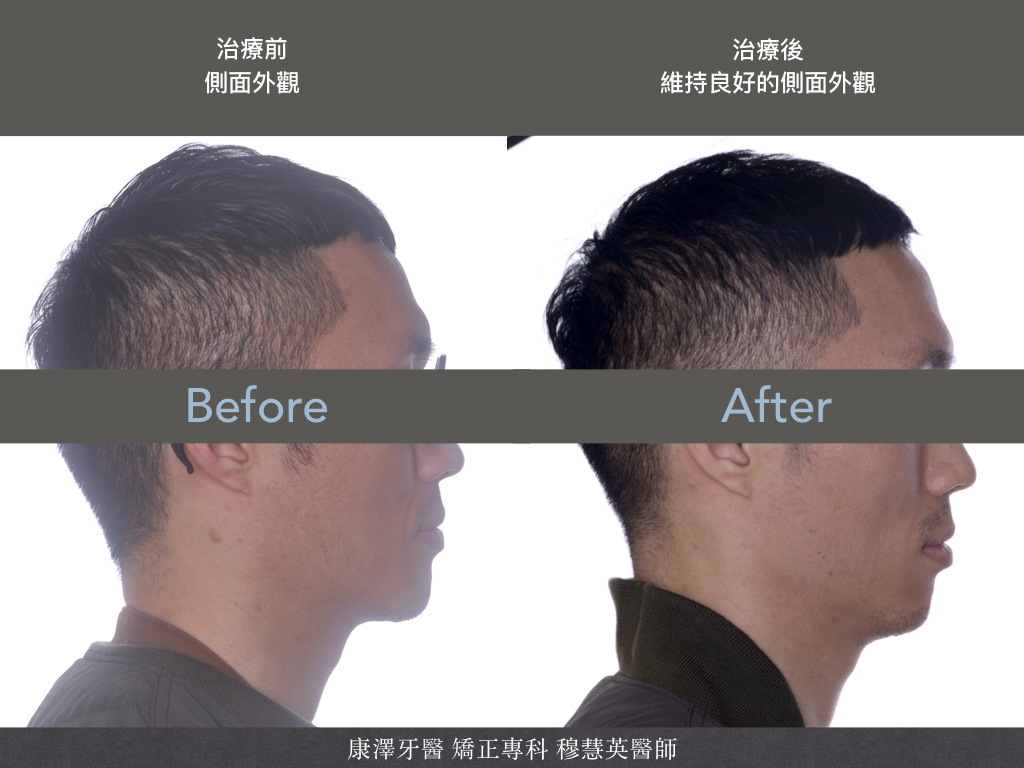 【矯正專欄】理想咬合的秘密:牙齒大小與數量的關鍵影響 【矯正專欄】理想咬合的秘密:牙齒大小與數量的關鍵影響