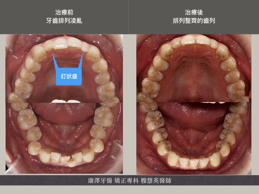 【矯正專欄】理想咬合的秘密:牙齒大小與數量的關鍵影響 【矯正專欄】理想咬合的秘密:牙齒大小與數量的關鍵影響