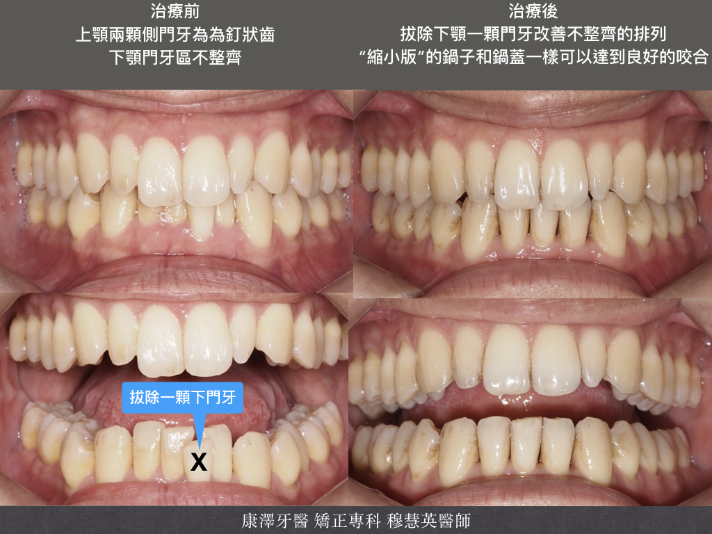 【矯正專欄】理想咬合的秘密:牙齒大小與數量的關鍵影響 【矯正專欄】理想咬合的秘密:牙齒大小與數量的關鍵影響